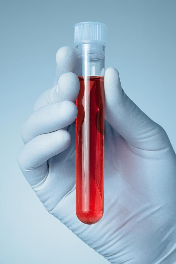 Autoimmune-Treatment Close up of a gloved hand holding a vial of red liquid, representing Frank Lanzisera, D.C.'s comprehensive autoimmune disorder treatment in Tampa Bay Metro.