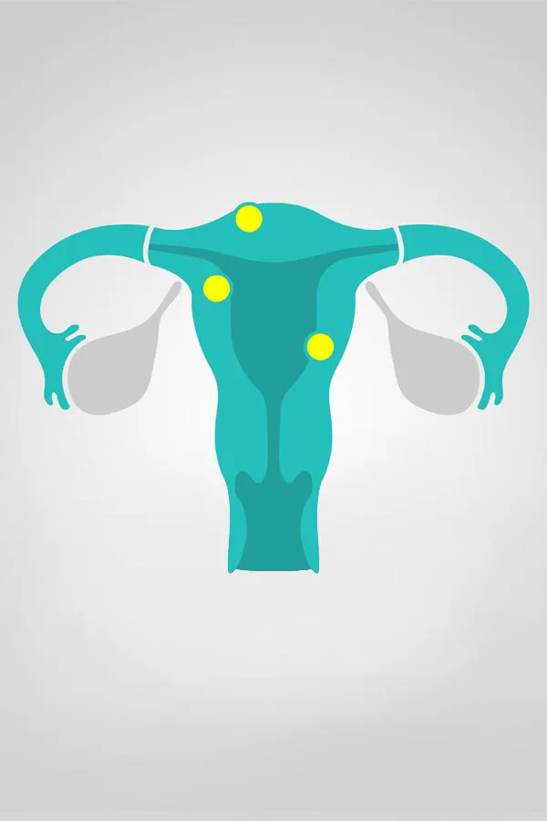 Fibroids-Treatment Illustration of a uterus with yellow dots indicating fibroids. Get treatment for fibroids from Frank Lanzisera, D.C. in Tampa Bay Metro.
