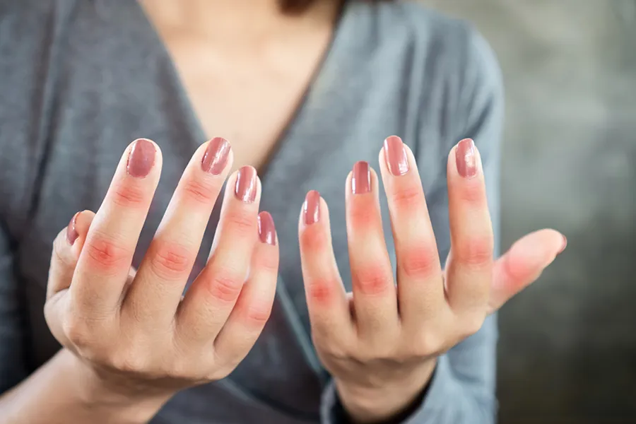 Lupus-Clinic Close-up of the hands of a woman in a gray shirt, with swollen, red knuckles. Get treatment for Lupus from Frank Lanzisera, D.C. in Tampa Bay Metro.