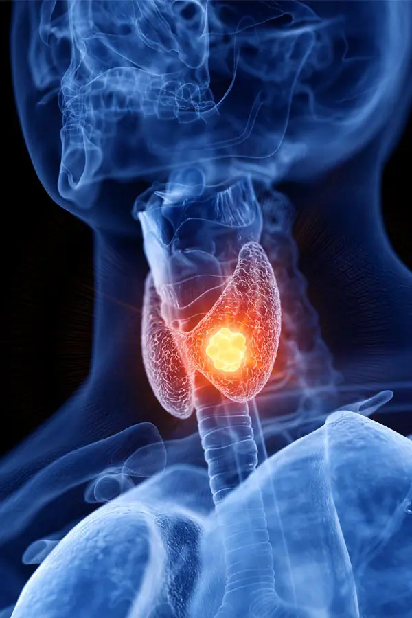 Thyroid-Imbalance-Treatment A 3D illustration of an x-ray of a human neck, highlighting the thyroid. Get help with thyroid imbalance from Frank Lanzisera, D.C. in Tampa Bay Metro.