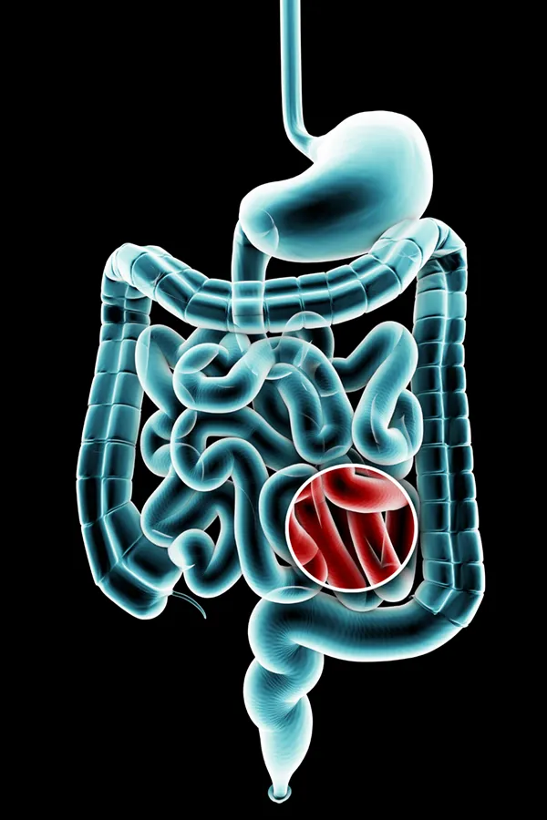 Ulcerative-Colitis-Treatment 3D illustration of the digestive system in blue tones, with an area of discomfort in red tones. Get treatment for Ulcerative Colitis from Frank Lanzisera, D.C. in Tampa Bay Metro.